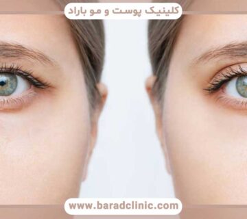 Eye shrinkage after blepharoplasty