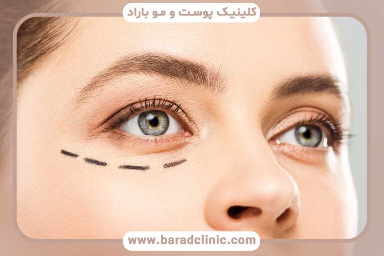 کلینیک مطمئن برای بلفاروپلاستی