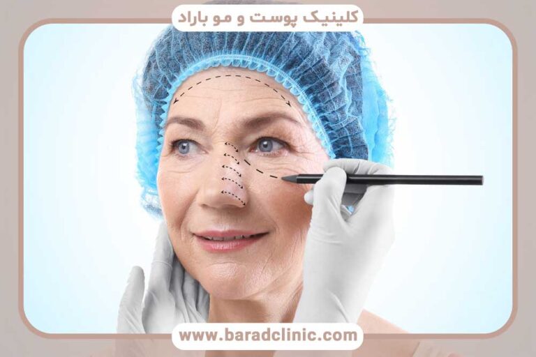 نقش پزشک متخصص در موفقیت جراحی بلفاروپلاستی