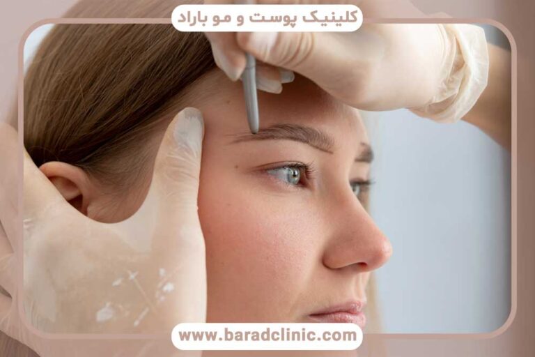 تراکم ابرو بعد از کاشت