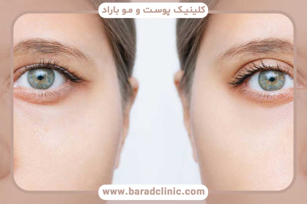 Eye shrinkage after blepharoplasty