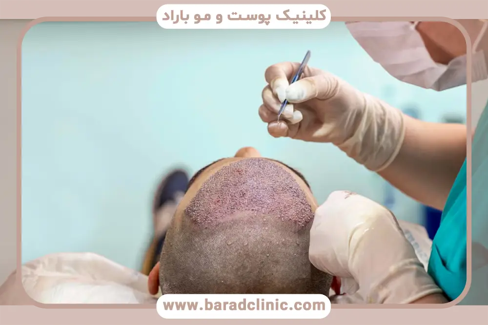 کاشت مو در تهران