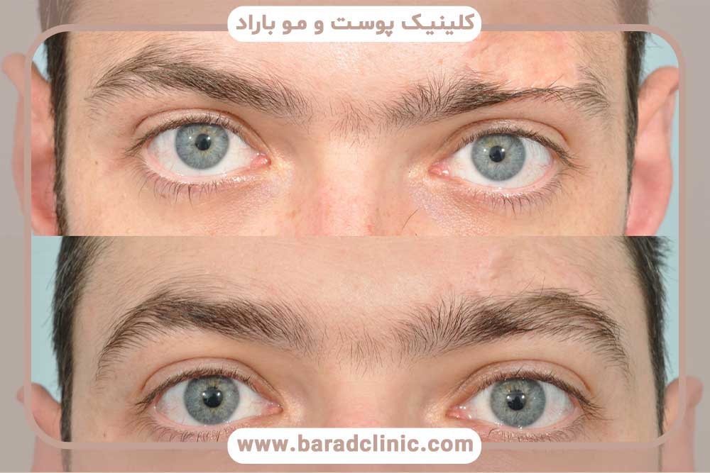 Eyebrow transplantation for scars