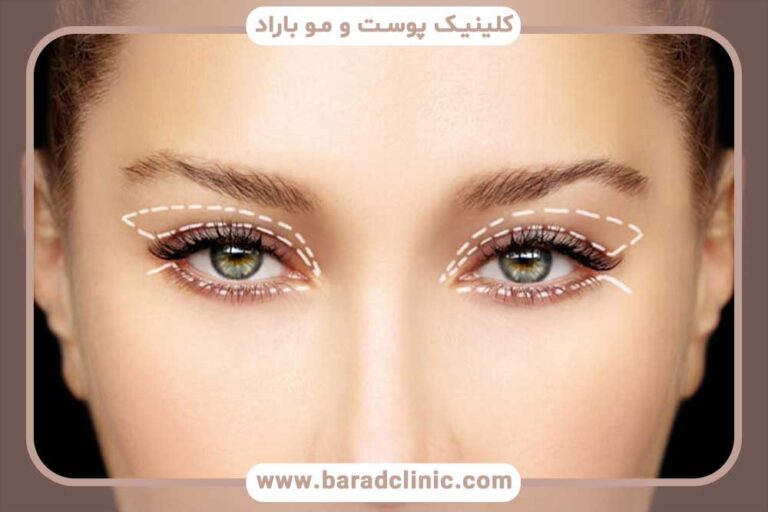 بلفاروپلاستی و جوانسازی چشم‌ها