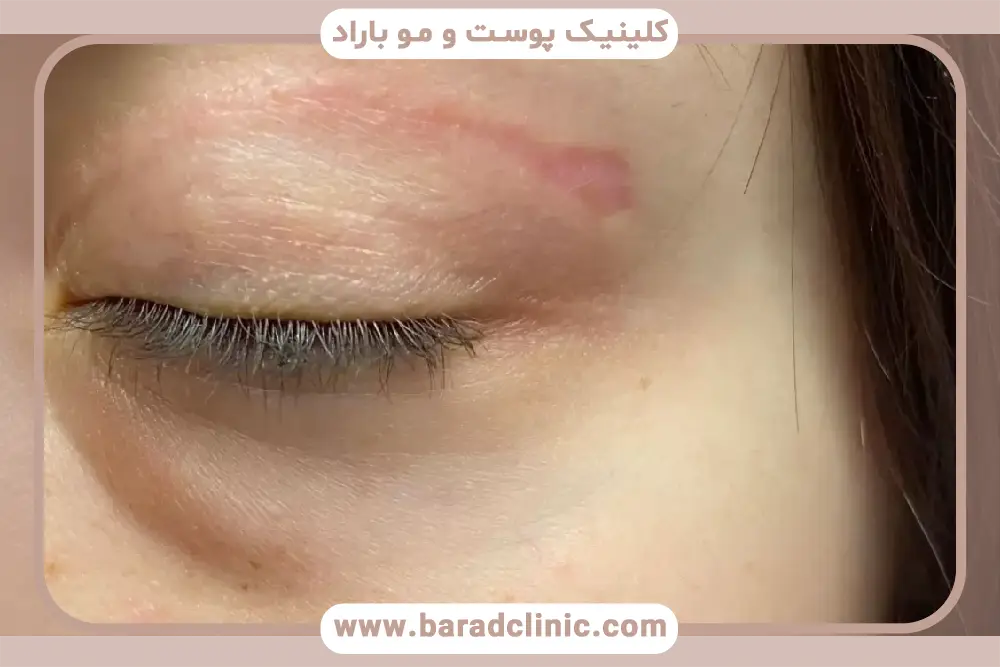 بهترین زمان اولین حمام بعد از بلفاروپلاستی 