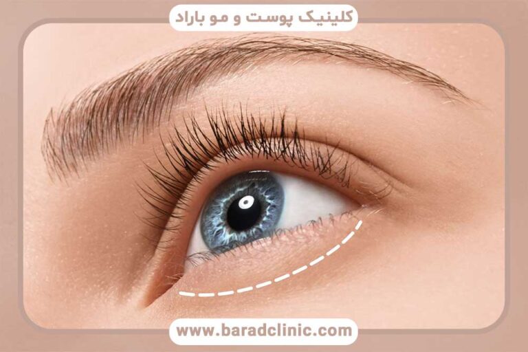 کلینیک مطمئن برای بلفاروپلاستی