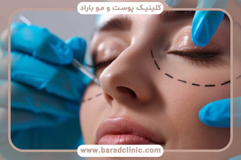 نقش پزشک متخصص در موفقیت جراحی بلفاروپلاستی