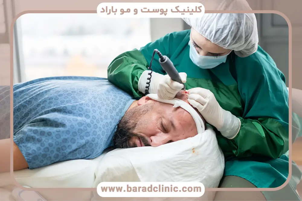 فرایند کاشت مو در تهران