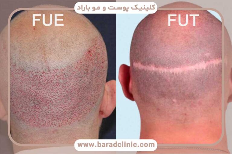 تفاوت کاشت ابرو به روش FUT و FUE