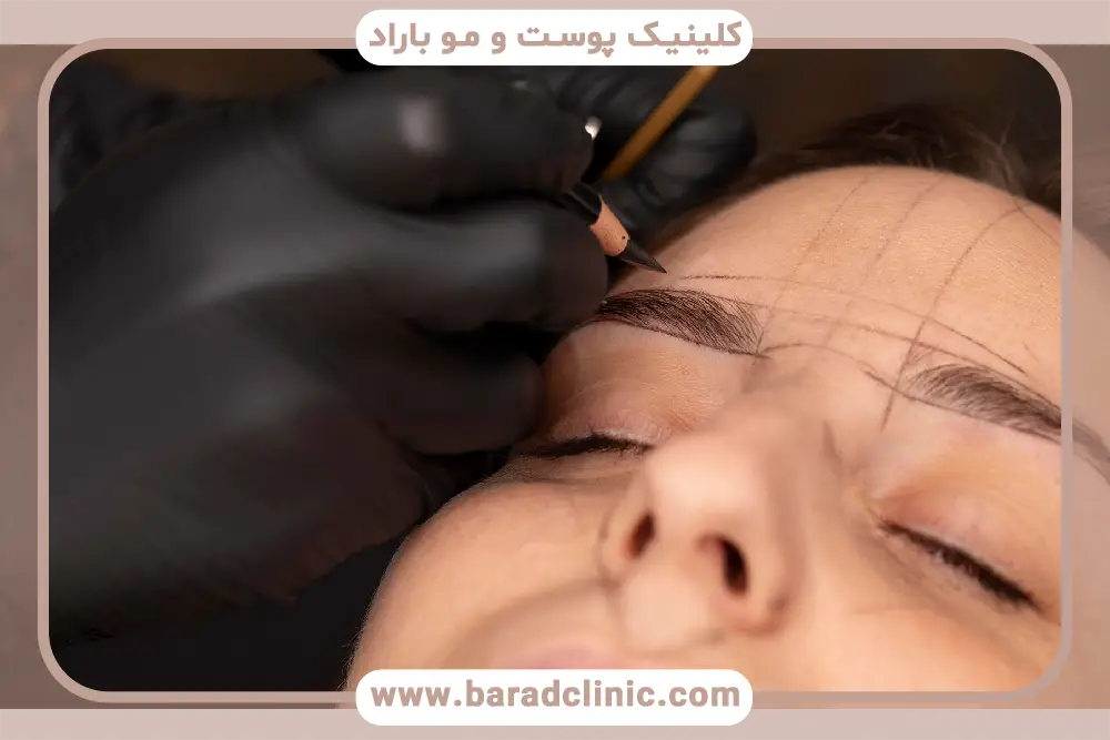 تجربه پزشک و تاثیر آن روی قیمت کاشت ابرو در تهران 