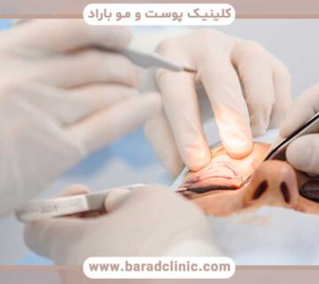 نقش پزشک متخصص در موفقیت جراحی بلفاروپلاستی