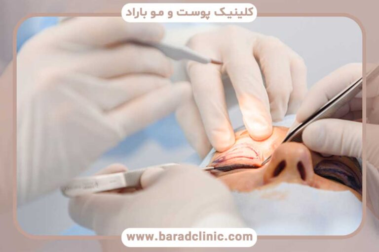 نقش پزشک متخصص در موفقیت جراحی بلفاروپلاستی