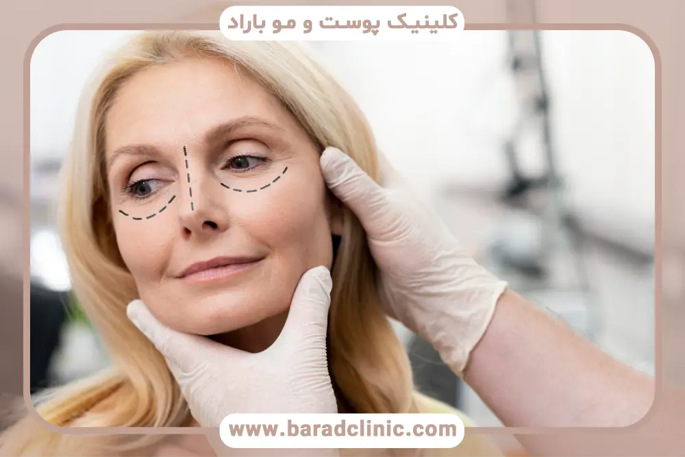 نکات مهم در حمام بعد از بلفاروپلاستی 