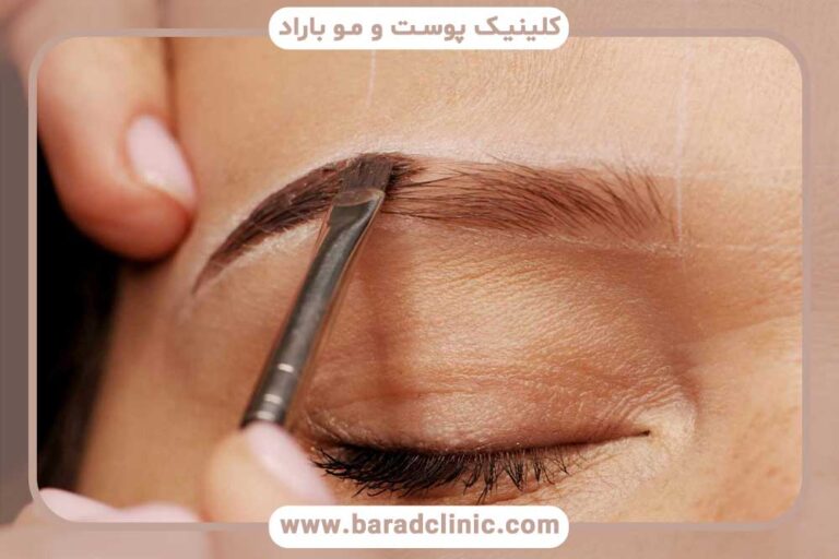 تراکم ابرو بعد از کاشت