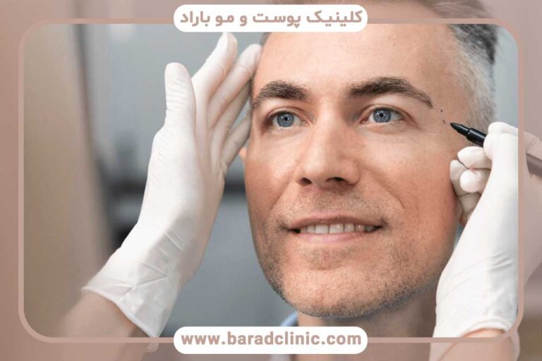 مراقبت‌های ضروری بعد از کاشت ابرو