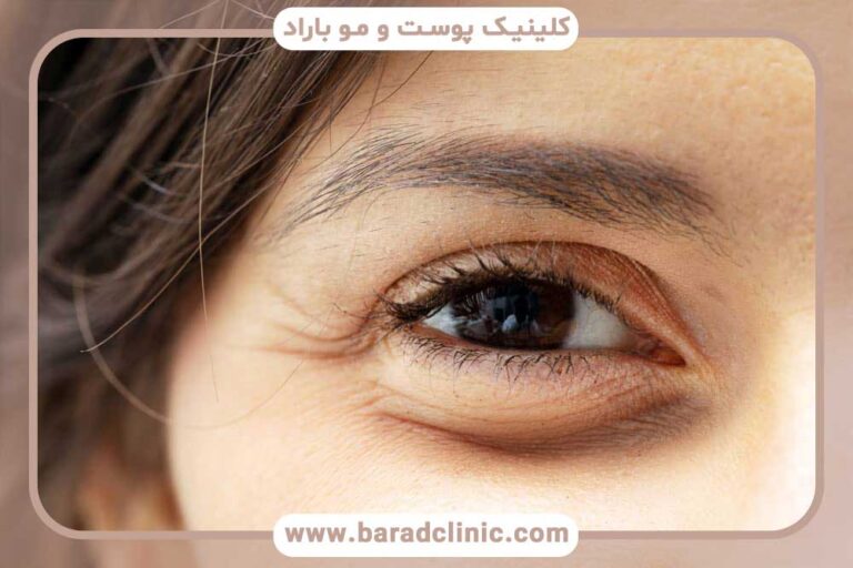 بلفاروپلاستی و جوانسازی چشم‌ها
