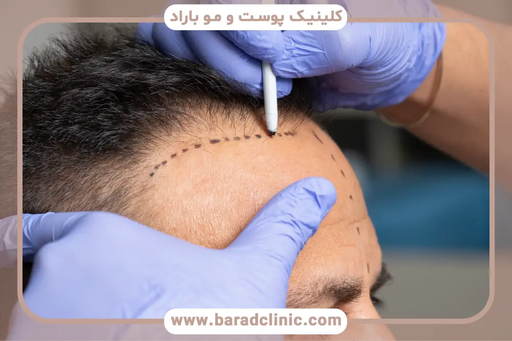 متدهای کاشت مو