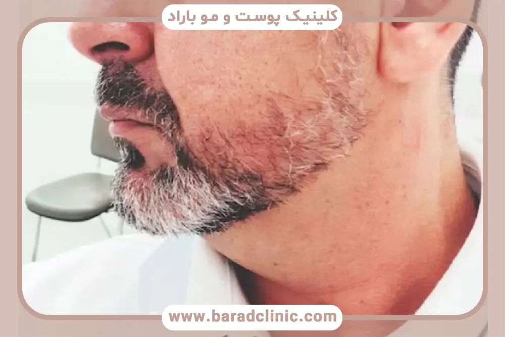 مشاوره درباره سن کاشت ریش 