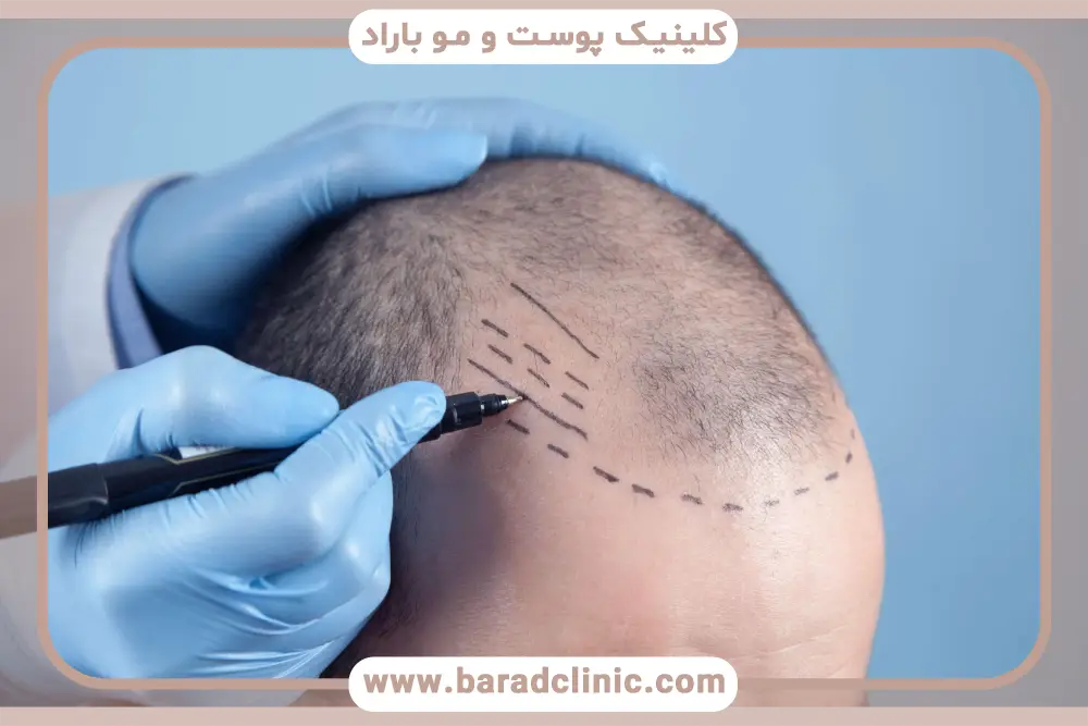 بهترین جراح کاشت مو در تهران