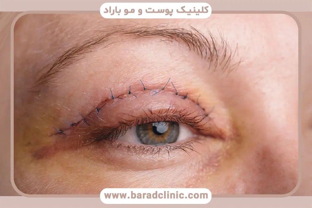 اشتباهات رایج در حمام بعد از بلفاروپلاستی 