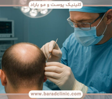 پزشک در حال آمادهسازی ناحیه گیرنده برای کاشت مو، تزریق بیحسی موضعی و فیلم کاشت مو
