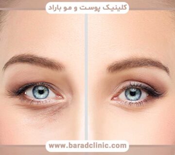 Blepharoplasty