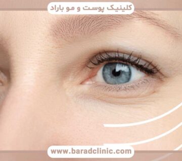 Blepharoplasty in women and men