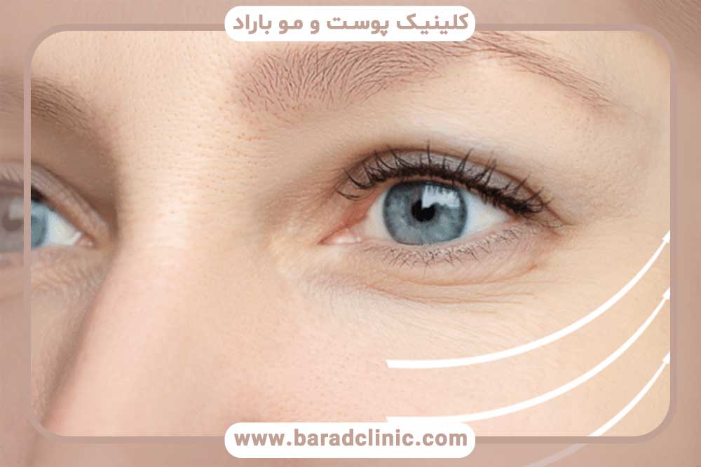 Blepharoplasty in women and men