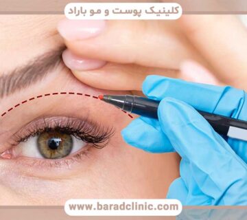 Laser in modern blepharoplasty