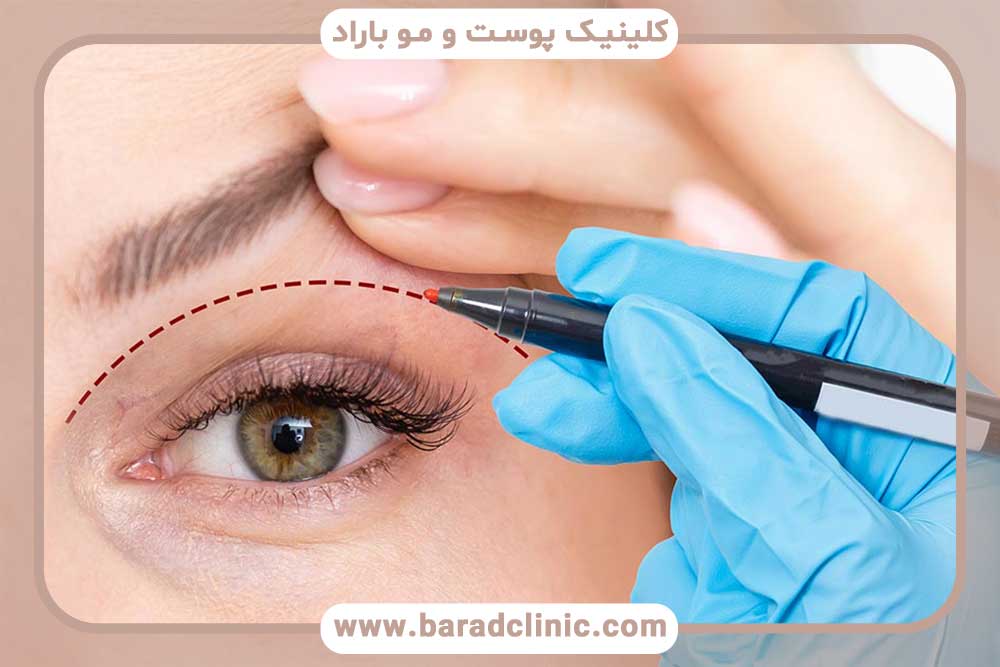 Laser in modern blepharoplasty