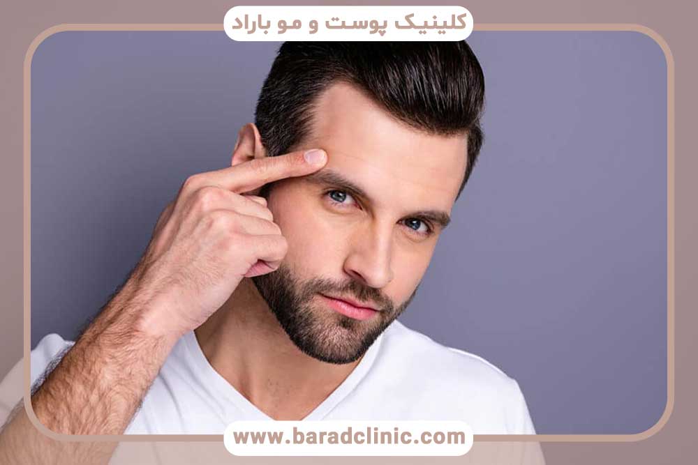 Eyebrow transplantation in men