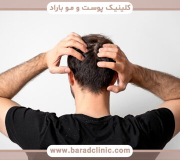رازهای موفقیت در کاشت مو سر و هرآنچه که باید بدانید.