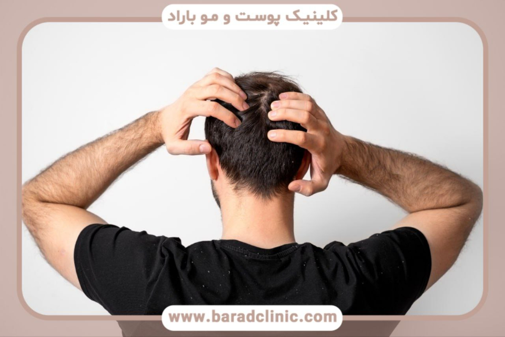 رازهای موفقیت در کاشت مو سر و هرآنچه که باید بدانید.