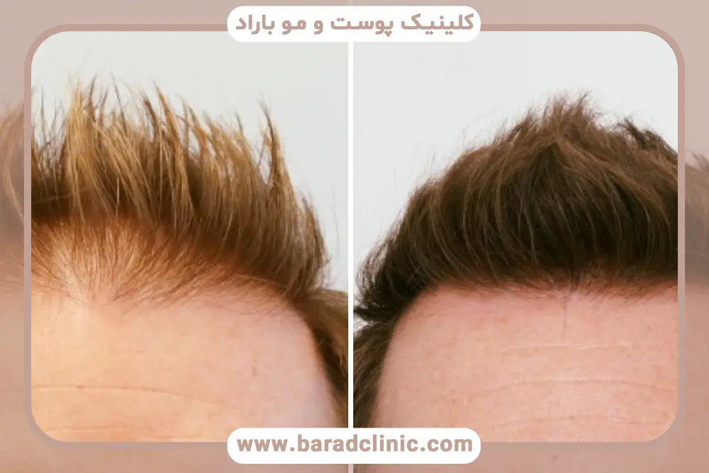 بهترین روش کاشت مو با تراکم بالا