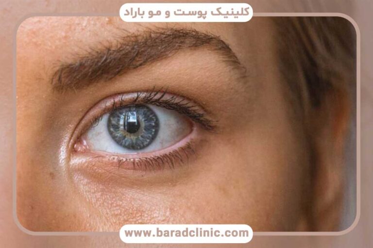 کاشت ابرو بعد از چند ماه طبیعی می‌شود؟