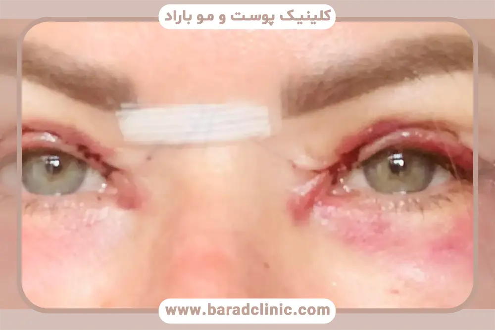 خونریزی بعد از بلفاروپلاستی