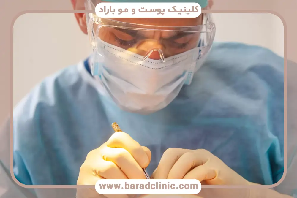 کاشت مو به روش تکثیری