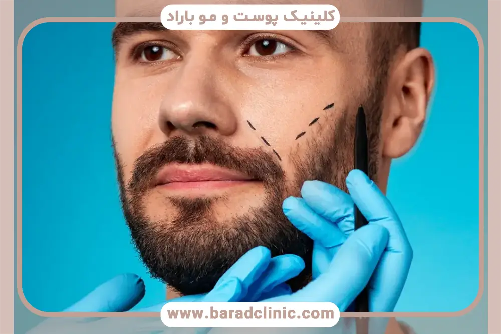 بهترین کلینیک کاشت ریش در تهران