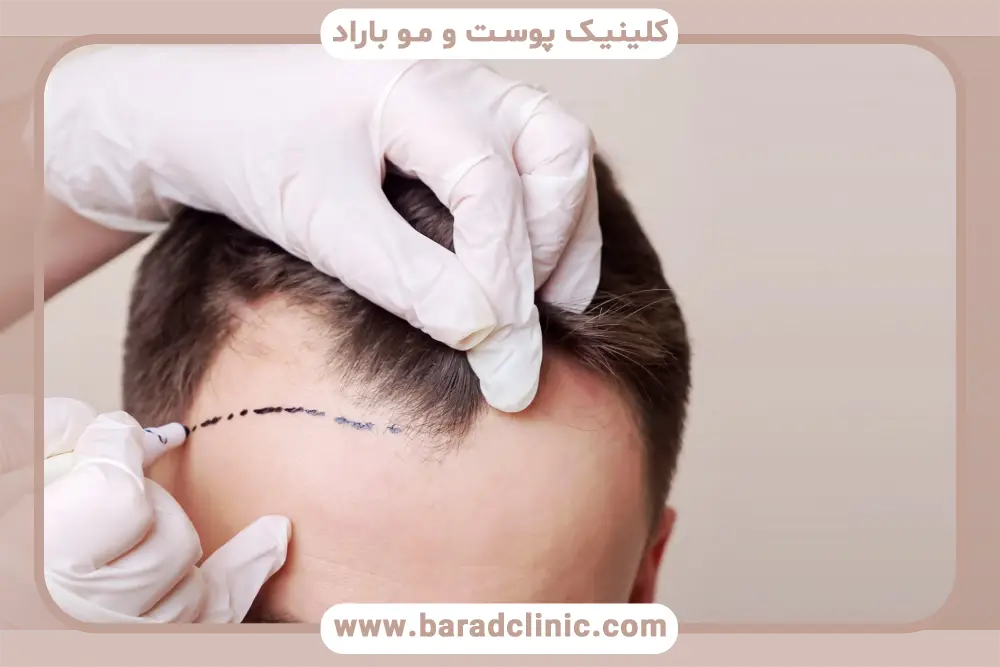 کاشت مو بعد از ۱۰ روز