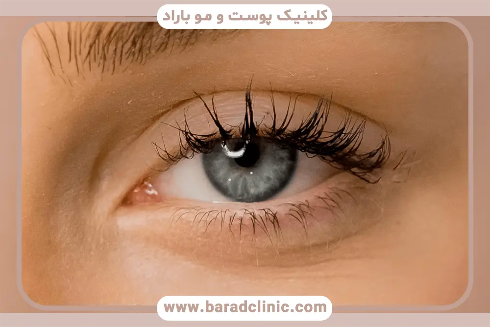 بلفاروپلاستی در تهران