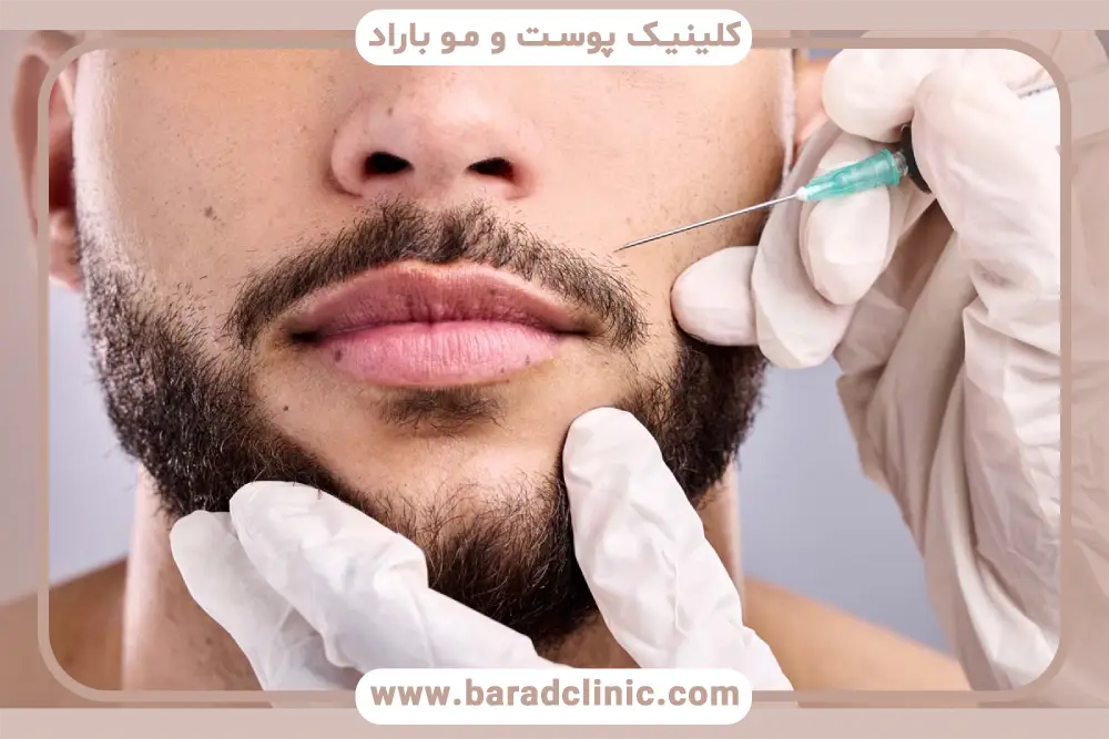 کاشت ریش اینستا