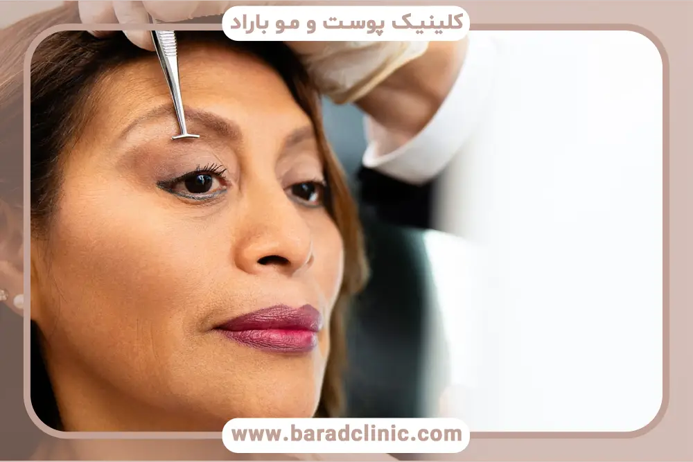 روش بلفاروپلاستی