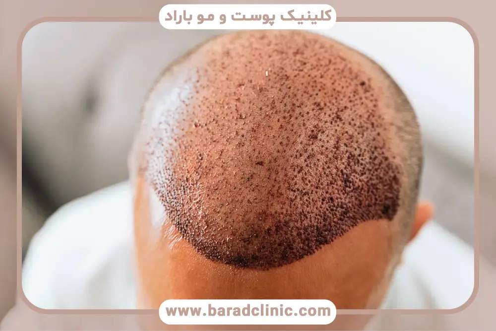 عکس کاشت مو