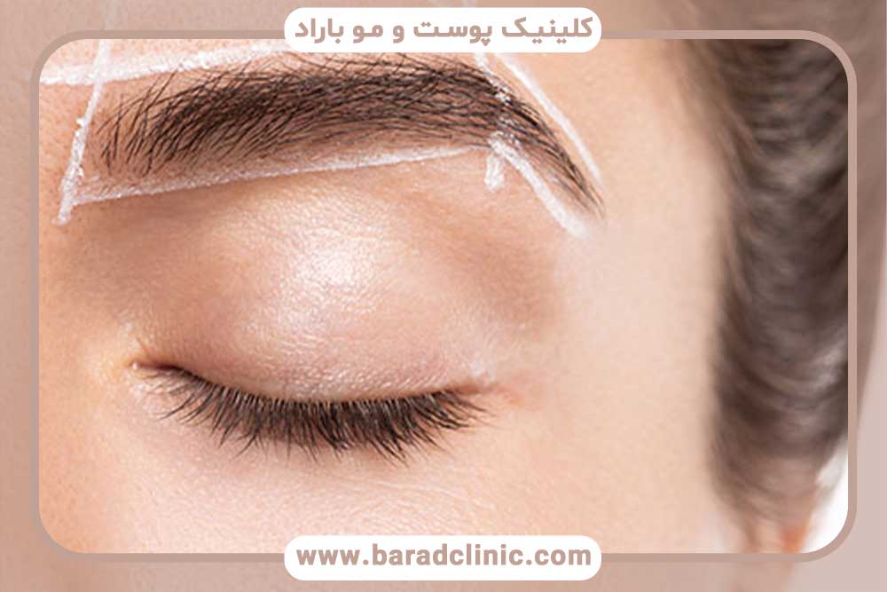 کاشت ابرو اقساطی در تهران