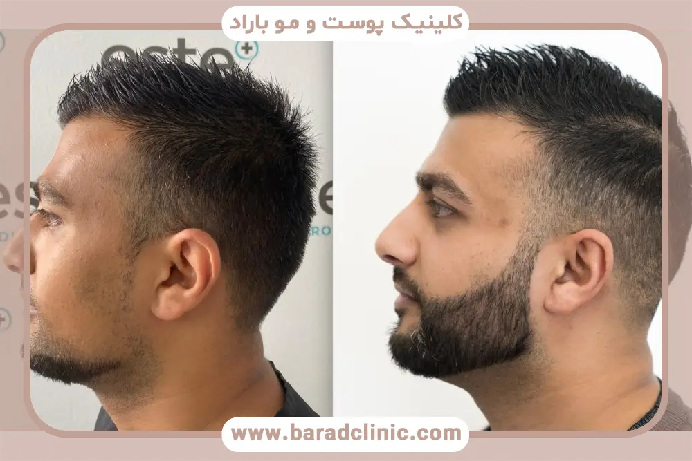 قبل و بعد کاشت ریش