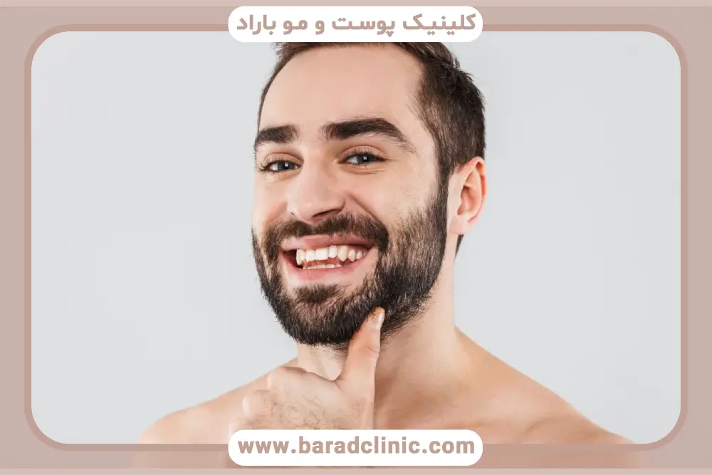 کاشت ریش صورت