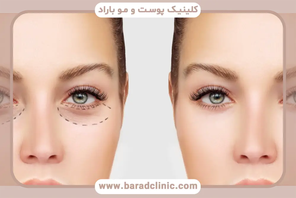 بلفاروپلاستی روز اول