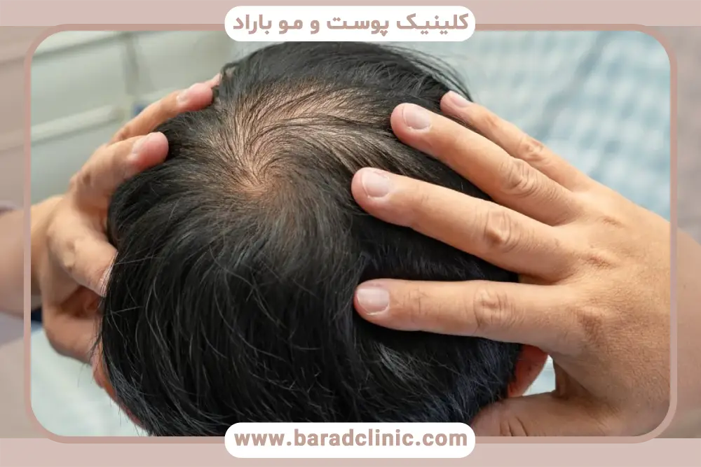 بهترین دکتر کاشت مو در تهران