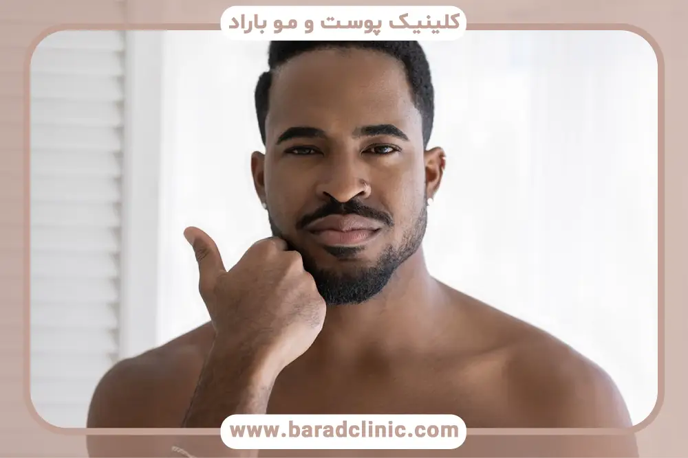 کاشت ریش و سبیل قبل و بعد