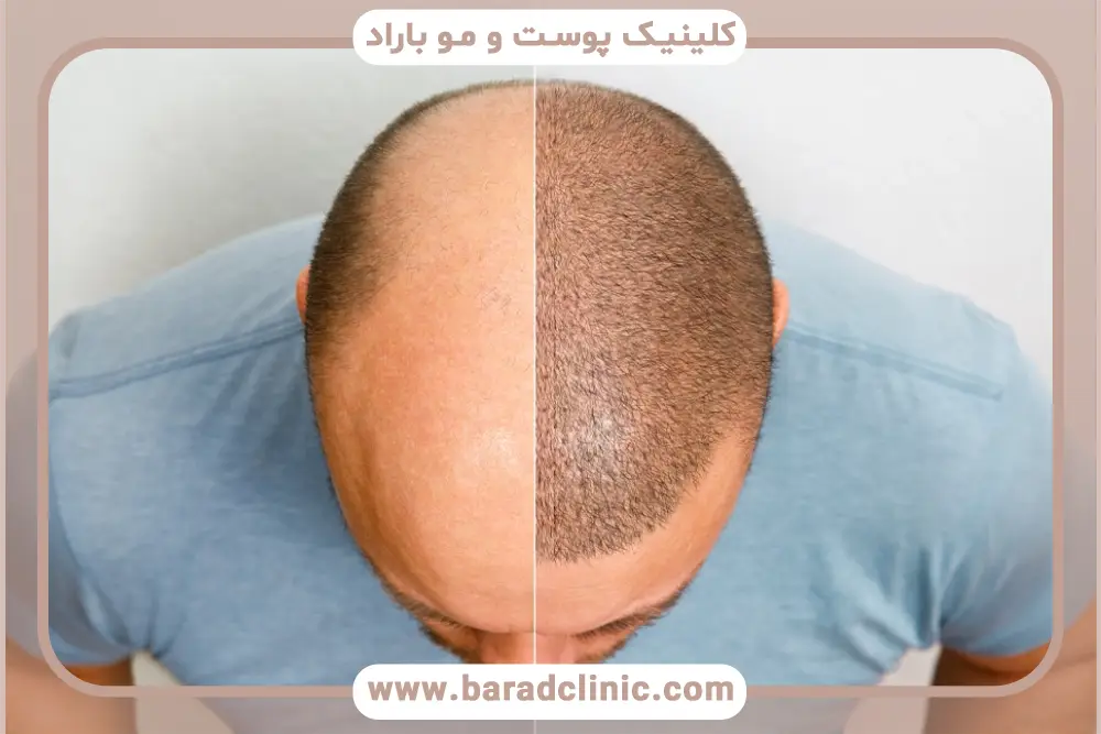 بهترین کاشت مو در تهران